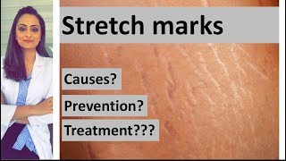 Stretch marks: causes, prevention, treatment | Dermatologist | Dr. Aanchal Panth