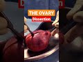 dissection of ovarian teratoma