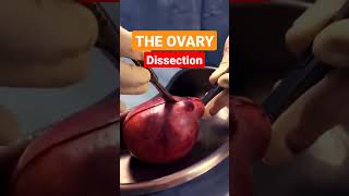 Dissection of Ovarian Teratoma