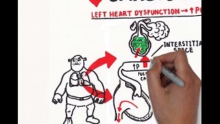 Pulmonary edema (USMLE step 1 )