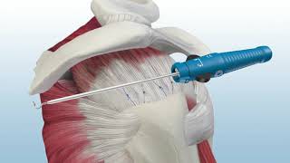 MEDHOLD single row rotator cuff augmentation using genesys crossft allopatch hd and poplok