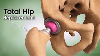 Total Hip Replacement (Surgery)  3D Animation