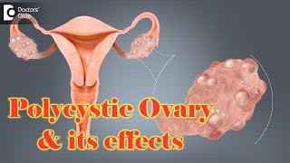 Polycystic ovaries and How does it trouble? - Dr. Usha B. R