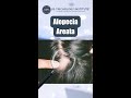 Alopecia Areata, one of the many types of hair loss