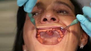 BPS Denture Basics