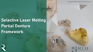 Utilizing Selective Laser Melting (SLM) for Partial Denture Frameworks