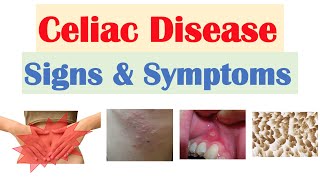 Celiac Disease Signs & Symptoms | Nutrient Deficiencies & Why Symptoms Happen