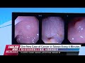 Diet, Lifestyle Keys to Preventing Colon Cancer｜20220822 PTS English News公視英語新聞