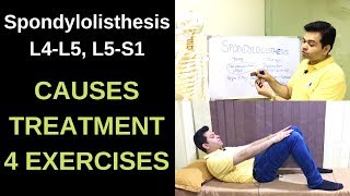 Spondylolisthesis L4-L5, L5-S1, Spondylolysis, Spondylolisthesis Treatment, Exercises- LOW BACK PAIN