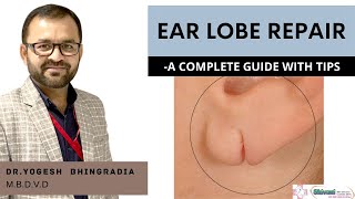 EAR LOBE REPAIR | A COMPLETE GUIDE WITH TIPS | DR YOGESH BHINGRADIA