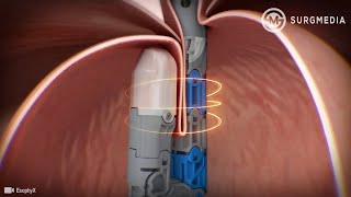 Endoscopic Treatment for  Gastro-Esophageal Reflux Disease (GERD or known as Acid Reflux)