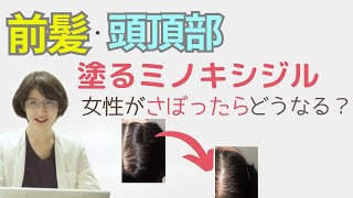 医師の本音アドバイス👉前髪・頭頂部：女性が【塗るミノキシジル】さぼったらどうなる？