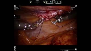 Robotic parastomal hernia repair