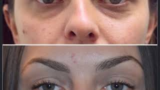 Under-Eye Treatment: Co2 and Filler