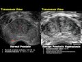 transrectal prostate ultrasound normal vs benign prostatic hyperplasia bph findings trus images