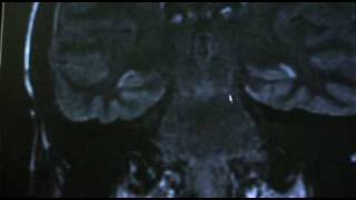 What's the difference between a stroke and a seizure?