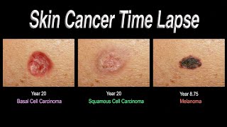 Skin Cancer Time Lapse (Basal Cell Carcinoma, Squamous Cell Carcinoma, Melanoma)