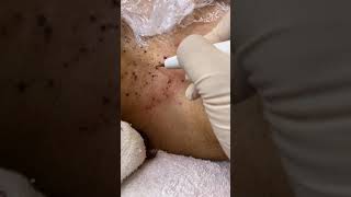 Warts Removal