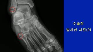 [강동구 정형외과 리더스병원]  발목(외과) \u0026 중족골 골절 수술사례