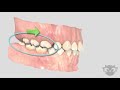 Orthodontic temporary anchorage devices