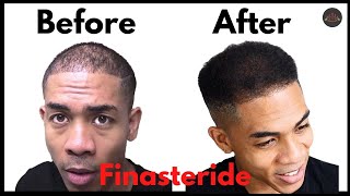17 Month Before and After Finasteride Update