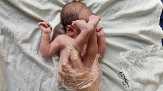 Newborn baby after  breech delivery birth with Flexible legs #newborn #baby #cute #girl