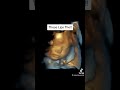 Baby Face Pictures on 4D Ultrasound at 34 Weeks Pregnant!