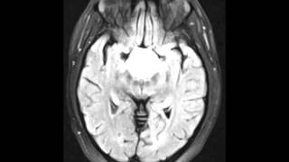 Adamantinomatous Craniopharyngioma