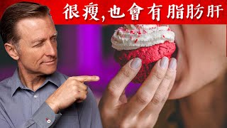 吃糖依舊很瘦?吃最多糖的國家?(不是美國)自然療法,柏格醫生 Dr Berg