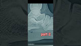 calcaneum #youtuber #doctor #youtubeshort