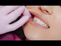 பற்களை அரைத்தல் என்றால் என்ன bruxism understanding teeth grinding and how to manage it