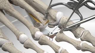 Toe Dislocation Repair with CPR™ Implant System