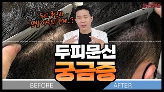 두피문신 VS 모발이식 따로? 또 같이? 누구보다 자연스럽게 유지기간 길게 풍성한 머리숱을 원한다면