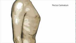 What is Pectus Carinatum?