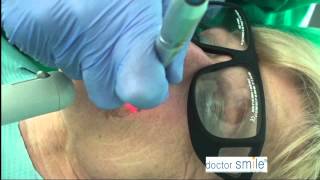 Copia di Doctor Smile Derma Fractional Handpiece Wrinkle removal