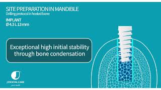 Implant Ø4.3 L13 - site preparation in maxilla and mandible