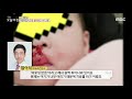 생방송 오늘 아침 어린이집서 인중 물어뜯긴 아이 왜 20200512