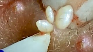 Remove Blackheads | What Your Remove Blackhead Should Popping | Capita CM 026