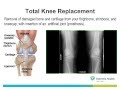 Learn about Knee Replacement - Essentia Health