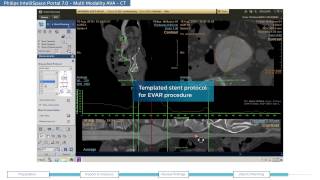 Philips IntelliSpace Portal 7.0 clinical application MM AVA(Multi Modality Advanced Vessel Analysis)