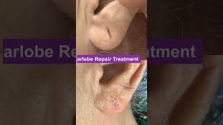 Eliminate Your Fears And Doubts About Ear Lobe Repair Treatment. | Viral #shorts