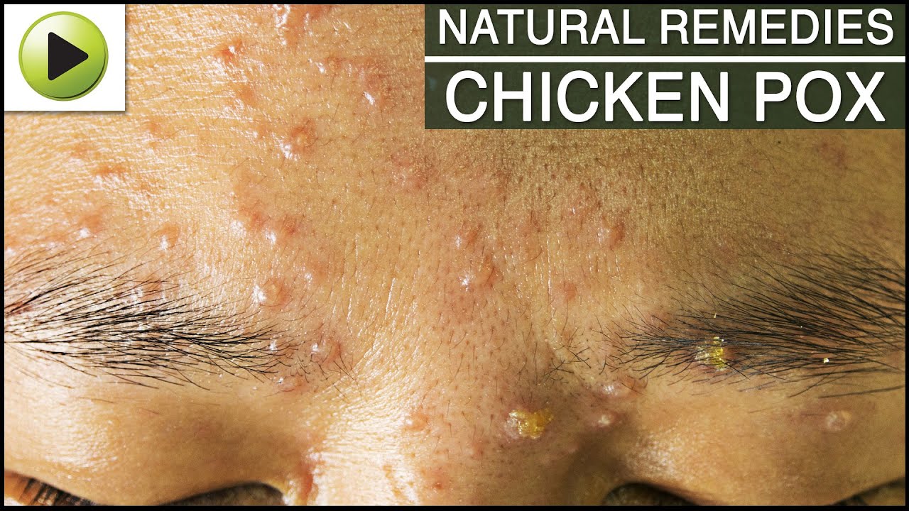 Skin Care - Chicken Pox - Natural Ayurvedic Home Remedies - YouTube