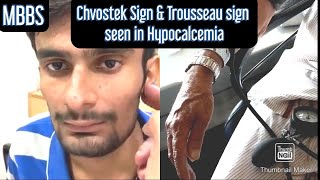 Chvostek Sign \u0026 Trousseau Sign seen in Hypocalcemia #mbbs #medicine #neetpg #usmle #inicet