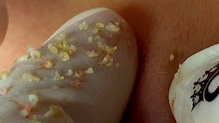 Big Pimples | Acne Treament Under The Skin #04 | Relax Every Day With Thuy Truong Sac Dep Spa | Acne