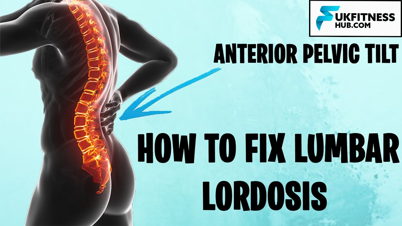 How To Fix Lumbar Lordosis And Anterior Pelvic Tilts - Full Exercise ...