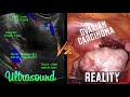 Ultrasound VS. Reality Part 2