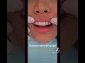 almost no prep emax porcelain veneers apostolified smile dentist beauty