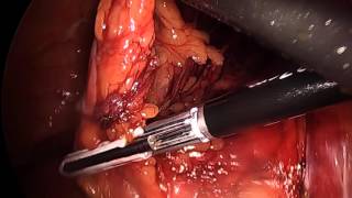 Transanal Total Mesorectal Excision (TaTME) with Stapled Anastomosis