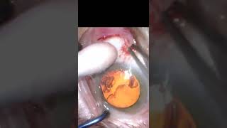 Pterygium surgery with sutureless autoconjunctival transplant at 20x speed