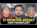 Hair Transplant in Bangalore | Best Results & Cost of Hair Transplant in Bangalore